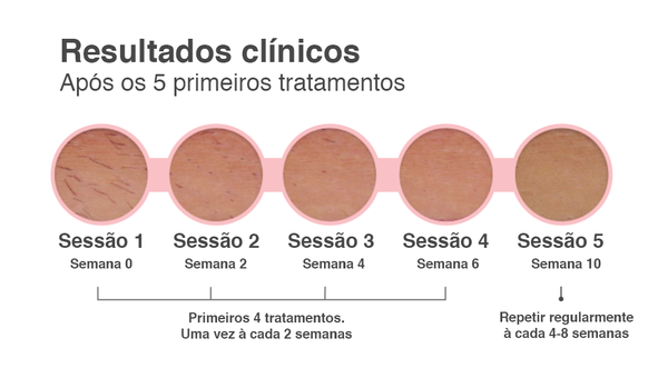 Depilador a Laser Permanente – Luz Pulsada IPL